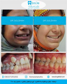 درمان ارتودنسی