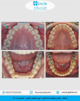 درمان ارتودنسی