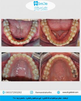 رفع بی نظمی دندان ها