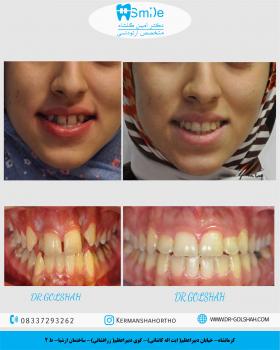 ارتدونسی ثابت بدون کشیدن