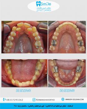 ارتدونسی ثابت بدون کشیدن