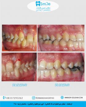 ارتدونسی ثابت بدون کشیدن