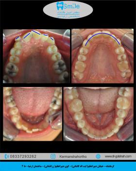 ارتودنسی ثابت دو فک بدون کشیدن دندان