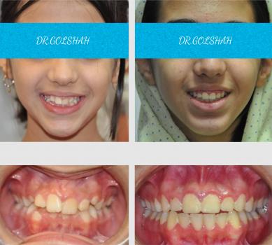 ارتودنسی ثابت دو فک بدون کشیدن دندان